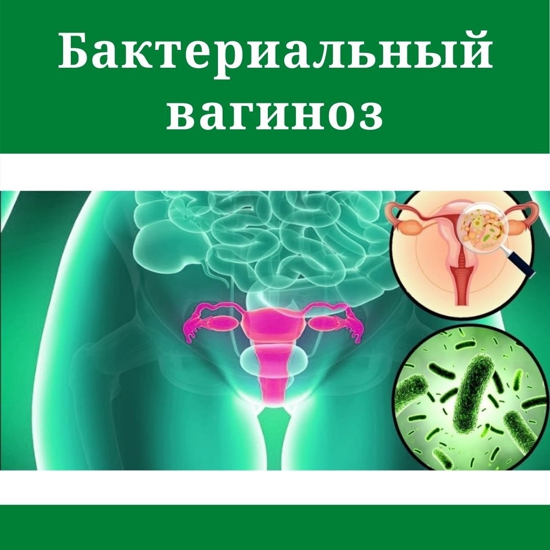 Бактериальный вагиноз 